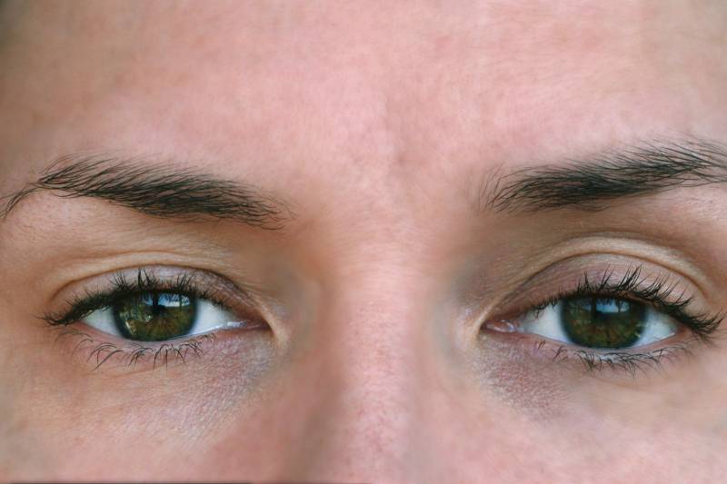 Chirurgie du ptosis : comment lutter contre les paupières tombantes